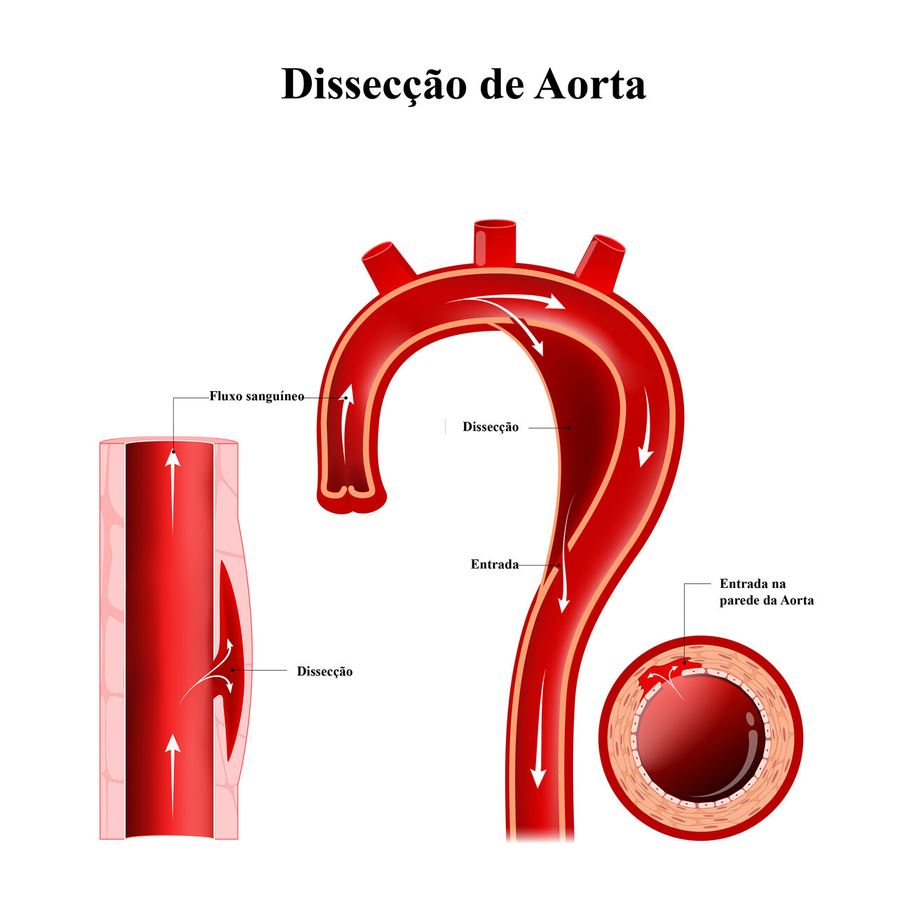 Aortic dissection. injury to the innermost layer of the aorta. blood to flow between the layers of the aortic wall. aortic arch. longitudinal and cross-section of blood vessel. Labeled Diagram. human anatomy. vector illustration (Aortic dissection. in